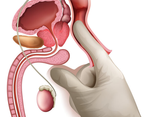 Why Does Fistula Cause Swelling Near the Anus?